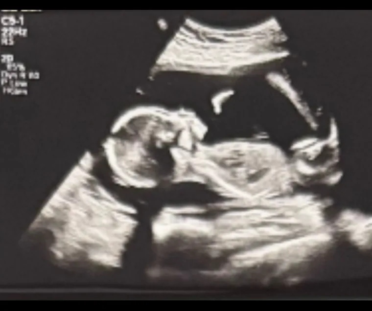 Ultrasound keepsake